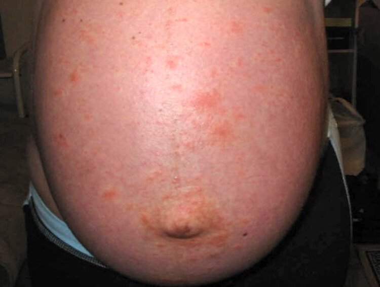 Skin Rash Pregnant 65