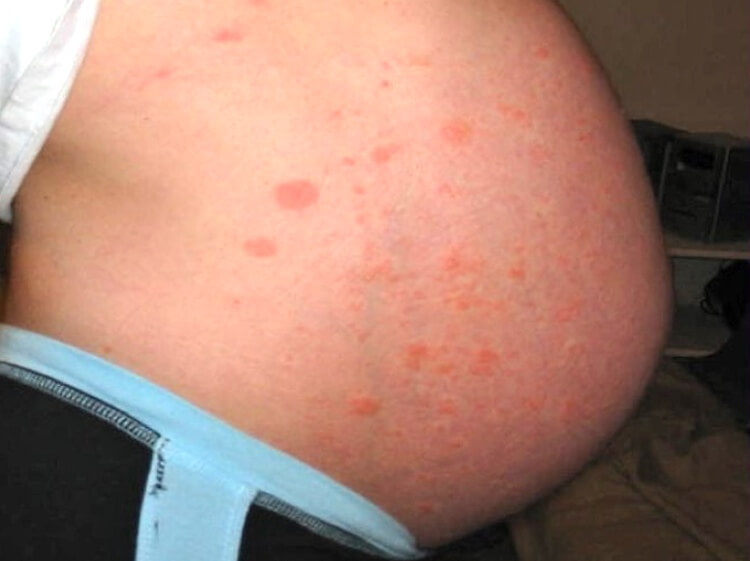 Pupps Rash In Pregnancy—natural Treatments Mama Natural