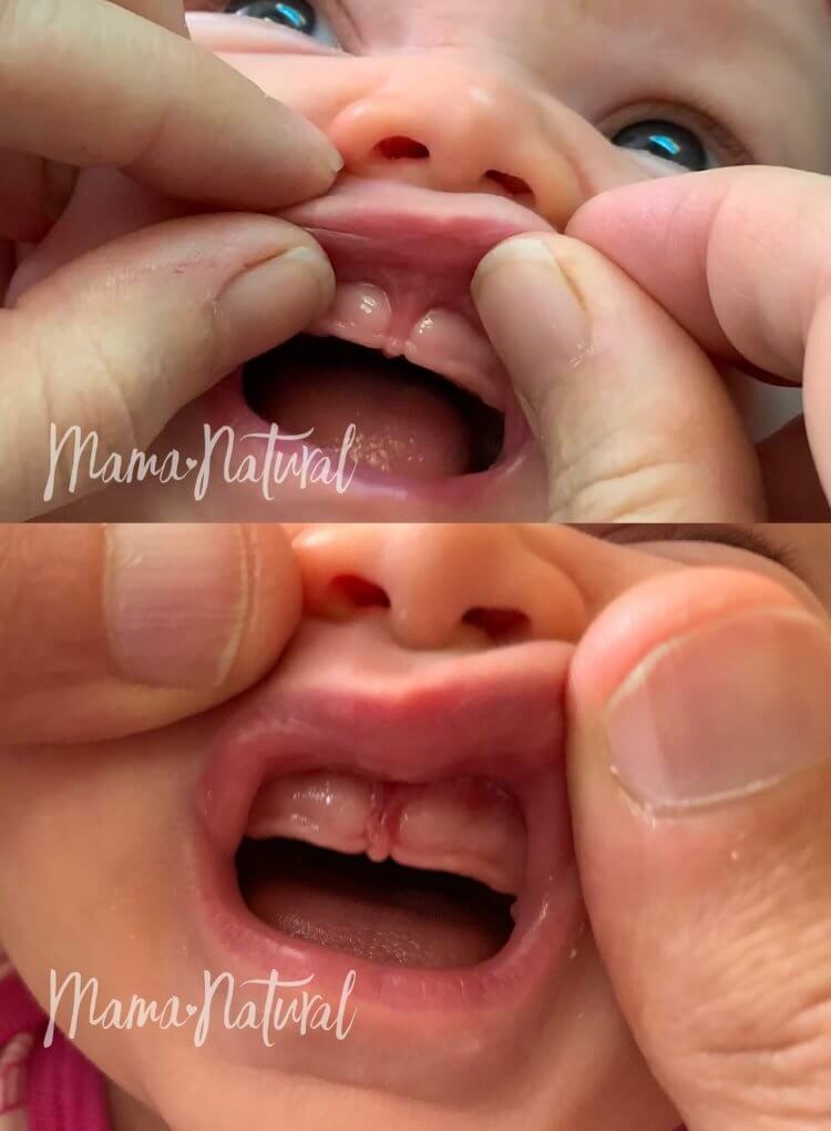 How to Tell If Baby Will Have Gap Teeth 