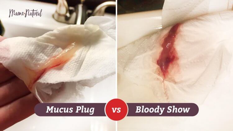 Mucus Plug and Bloody Show