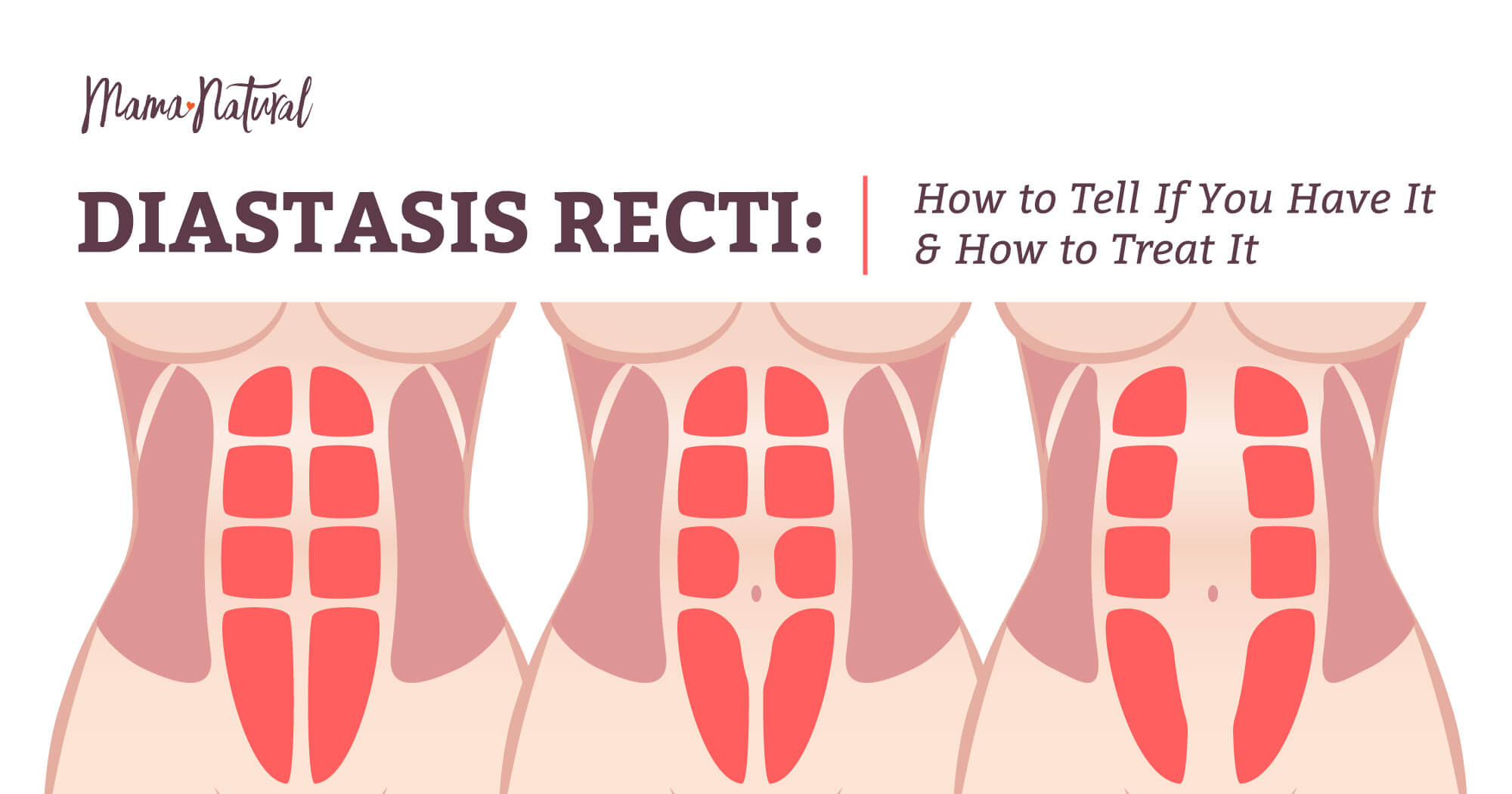 Diastasis Recti: Do You Have It? Plus How to Treat It