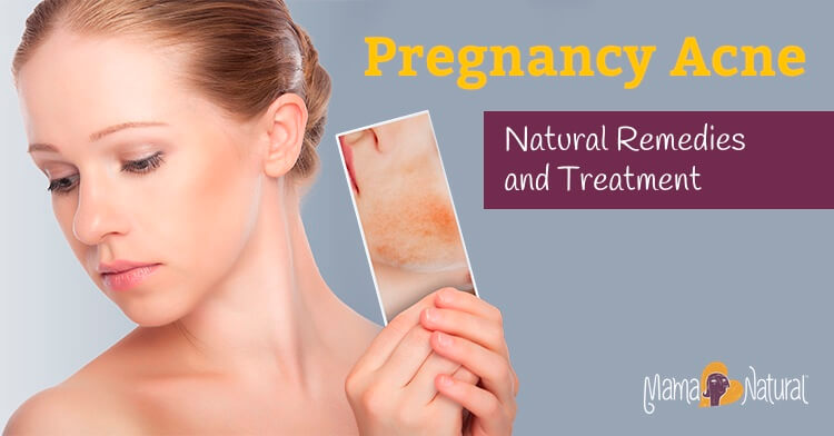 Pregnancy Acne: Natural Remedies