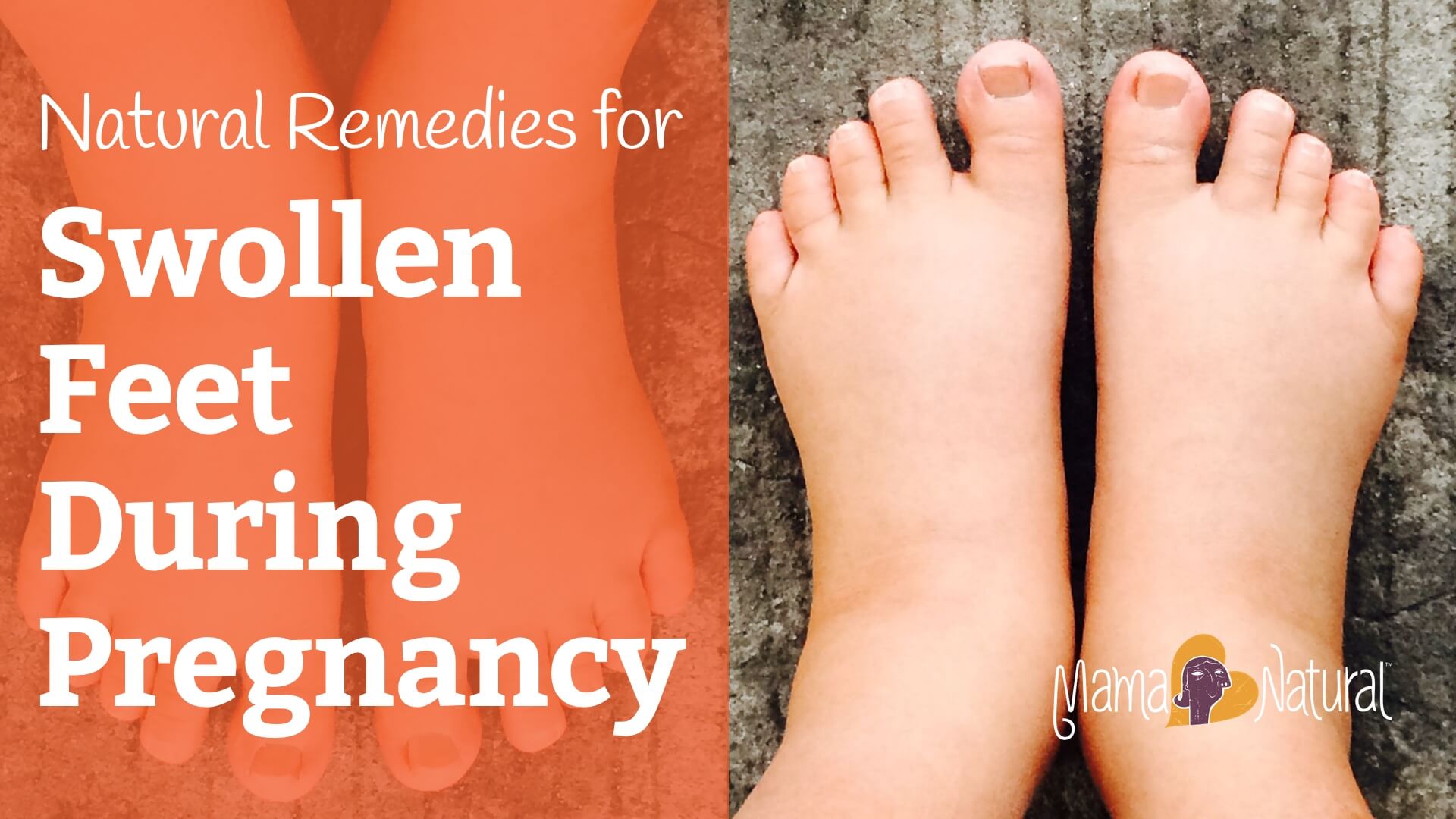 Swollen Feet During Pregnancy Natural Remedies