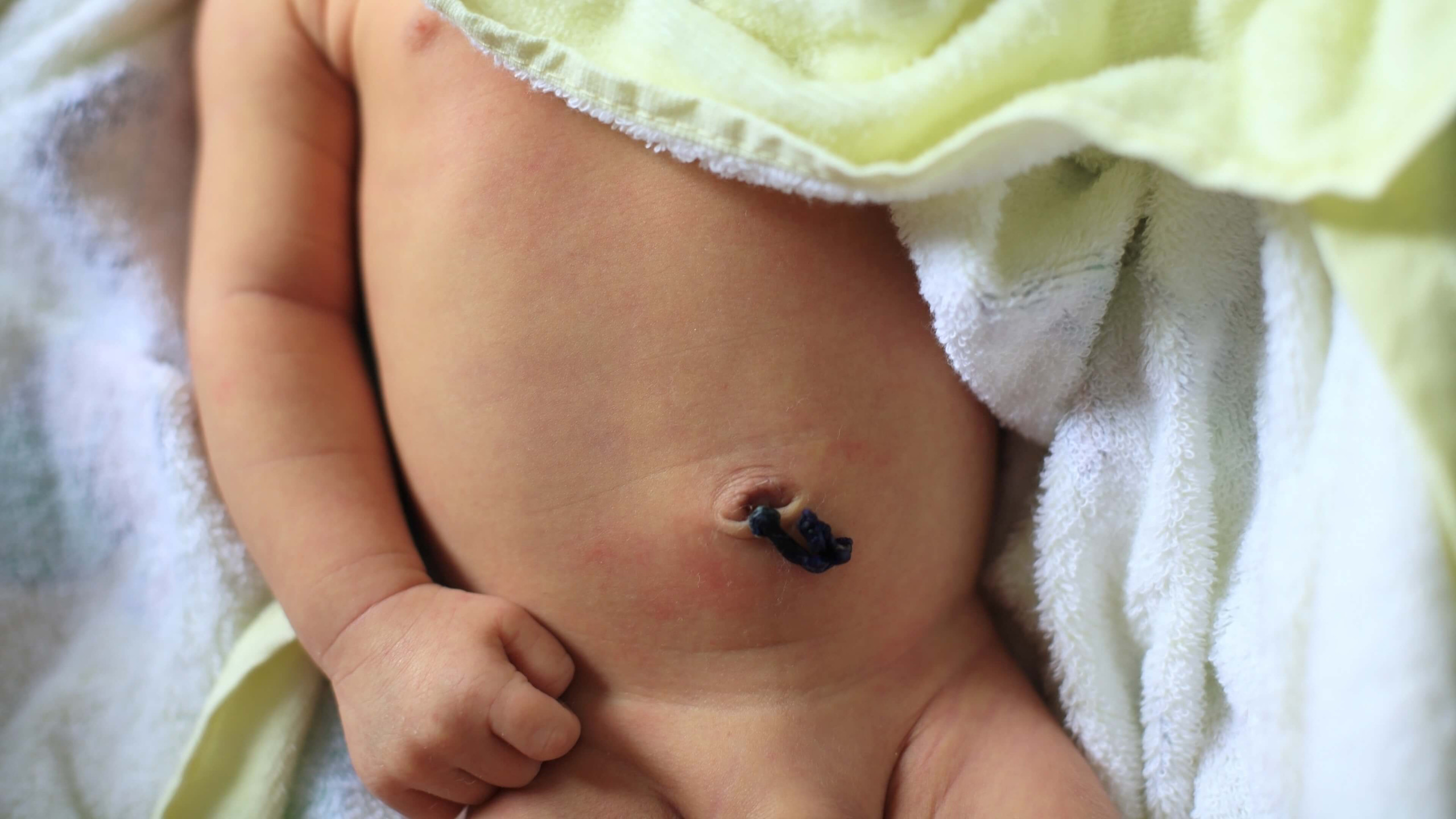 What To Do If Your Baby's Umbilical Cord is Bleeding