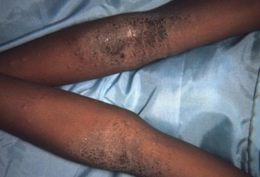 eczema black baby